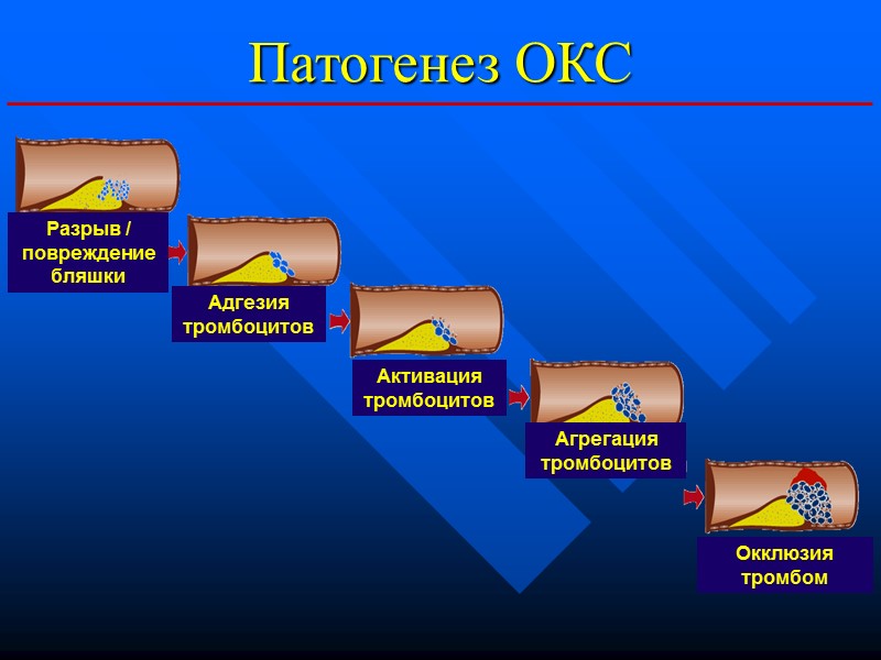 Патогенез ОКС Разрыв / повреждение бляшки Адгезия тромбоцитов Активация тромбоцитов Агрегация тромбоцитов Окклюзия тромбом Патогенез ОКС Разрыв / повреждение бляшки Адгезия тромбоцитов Активация тромбоцитов Агрегация тромбоцитов Окклюзия тромбом